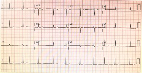 what does borderline ecg mean|Electrocardiogram (EKG/ECG) .